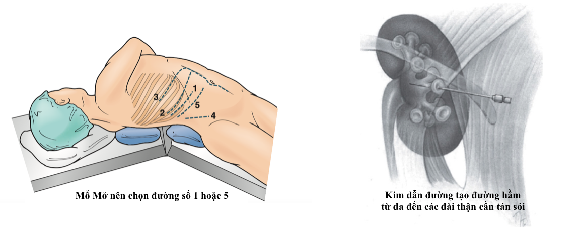 Mổ mở và mổ nội soi (PCNL), trong sỏi Thận